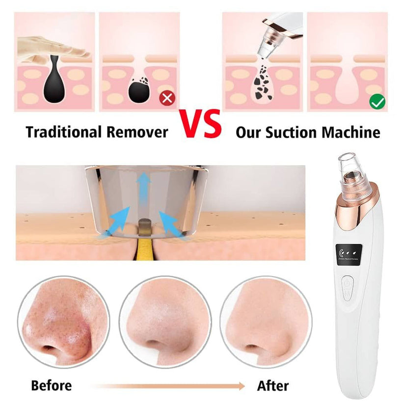 Original Imported 5-in-1 Rechargeable Blackhead Remover & Face Pore Vacuum Cleaner | Deep Clean | 30% OFF Today Only